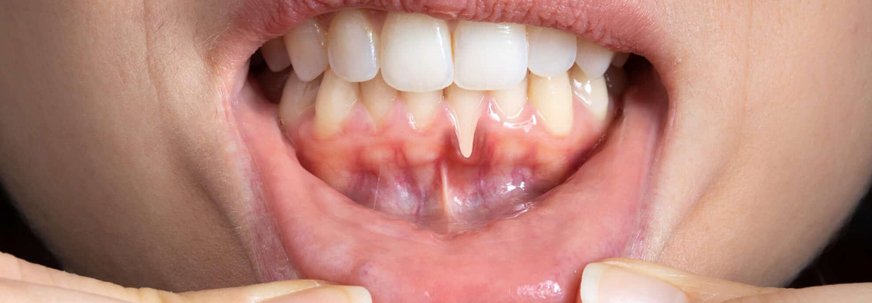 Gum Disease Treatment in Musaffah