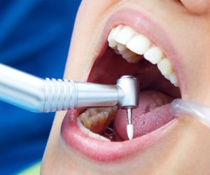 Tooth Filling